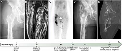 Impact of Heterotopic Ossification on Functional Recovery in Acute Spinal Cord Injury